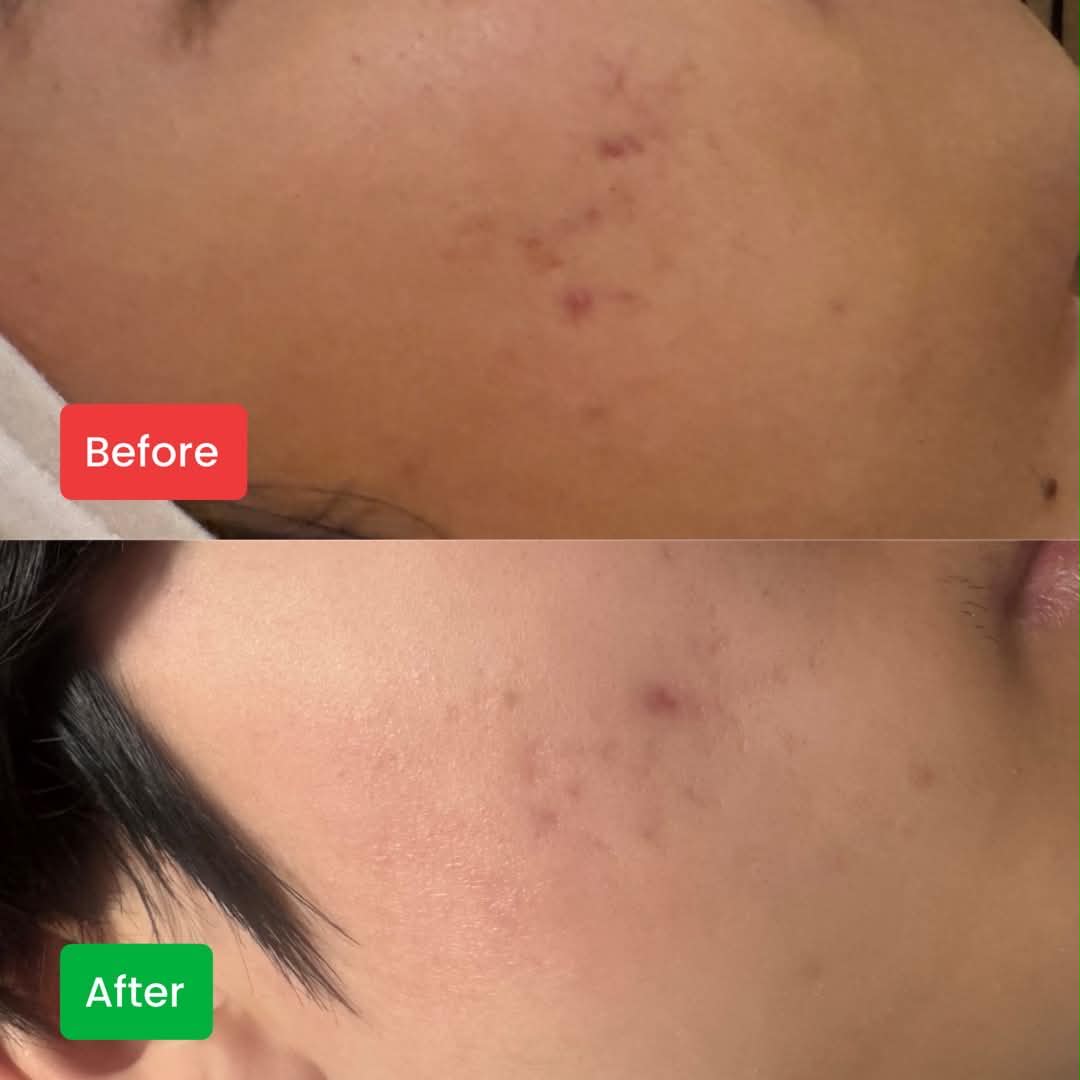 Résultat avant et après un soin microneedling